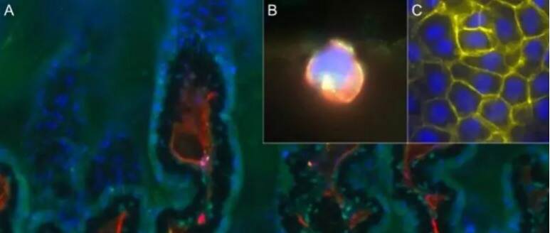 新研究发现:糖尿病性白内障出现在高血糖之前,挑战了长期以来关于糖尿病性白内障发展的“糖假说”